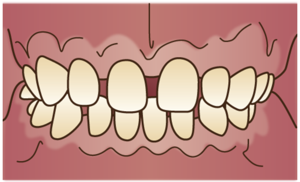 函館・歯科・マウスピース矯正